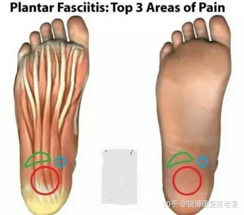 扁平足才懂的痛 足底筋膜炎 知乎
