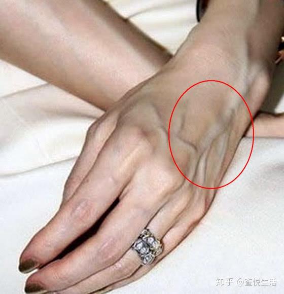 为什么有的人手上青筋特别明显?医生:这种情况是病! - 知乎