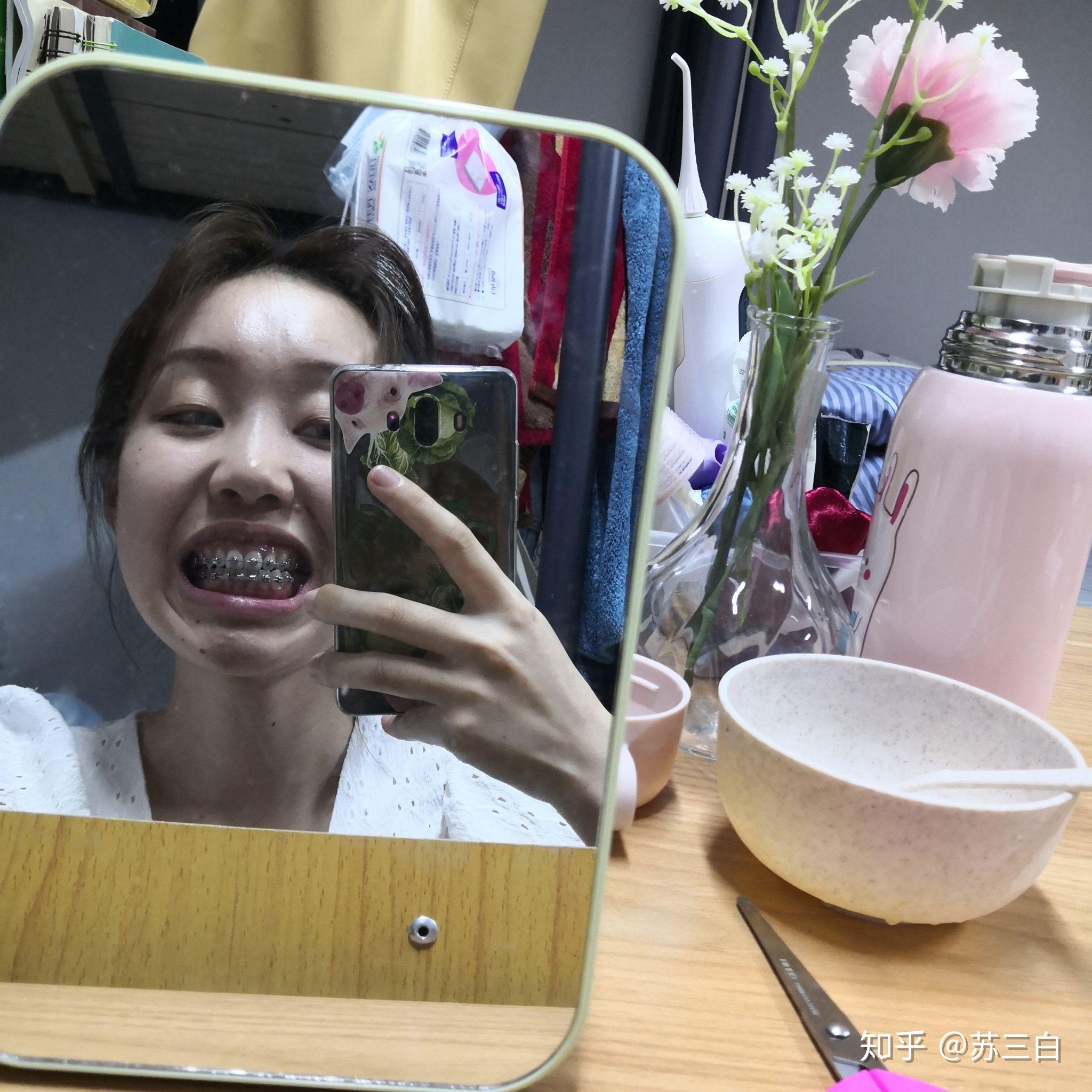 骨性嘴凸,牙齿矫正,上海口腔病防治院