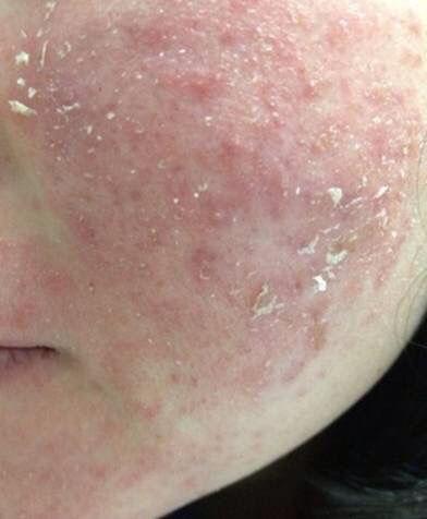 激素脸干,紧绷,脱皮怎么补水