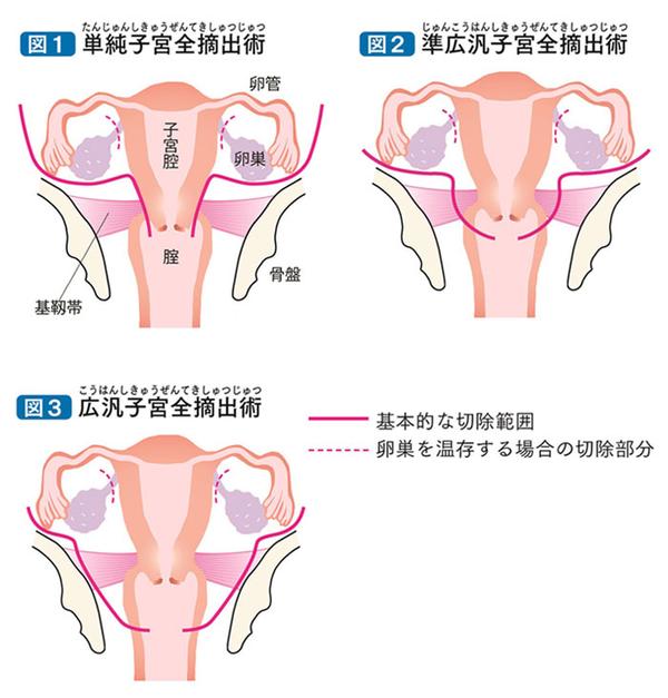 宫颈癌的防治 知乎