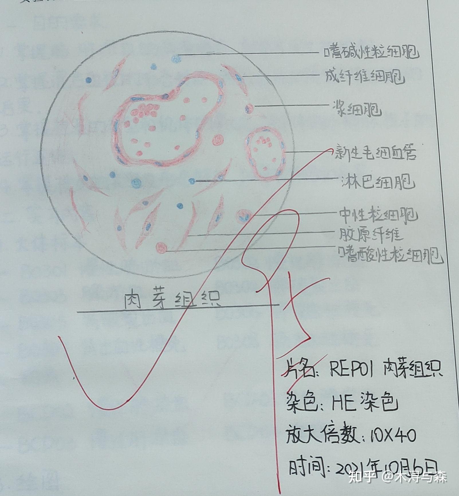 淀粉样变性红蓝铅笔图图片
