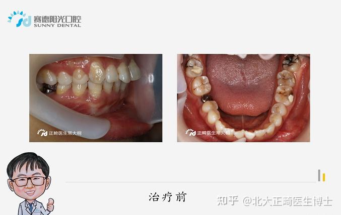 鄭州牙齒矯正醫生常大桐隱適美矯治嘴突牙不齊前牙內收側貌改善為直面