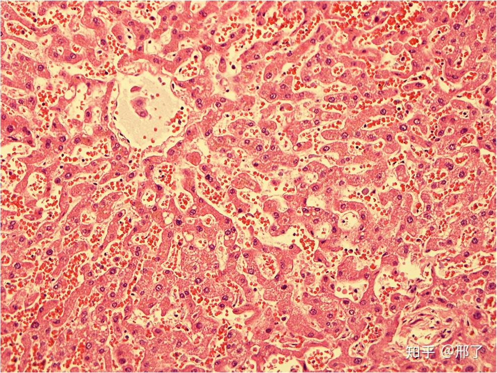皮细胞坍陷 (图1), 细胞萎缩(图2和图3), 血红素(图4)和肝窦扩张(图5)