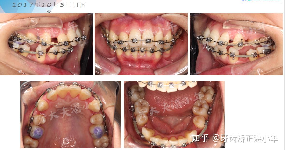 長沙牙齒矯正骨性齙牙案例論牙齒的重要性