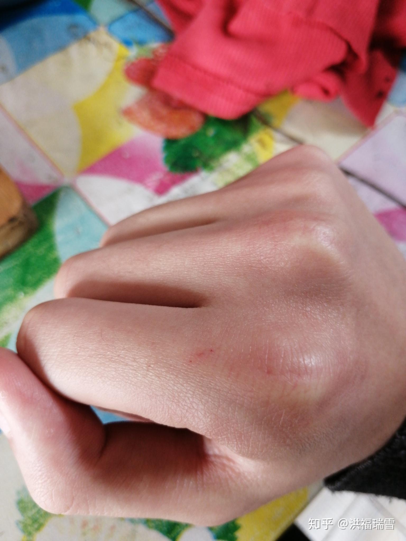 被猫抓了没出血破了一丁点一丁点的皮猜问需要打疫苗吗