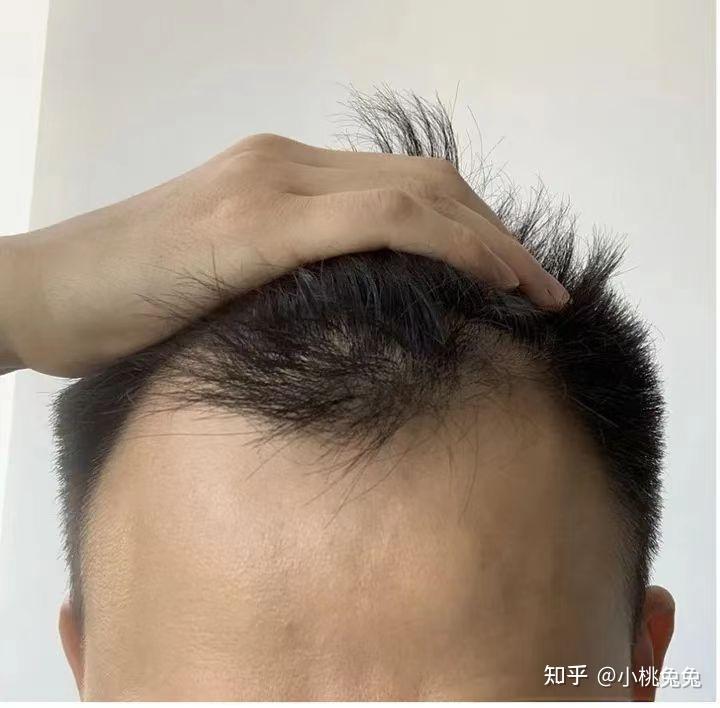 南京植发效果选新生3d植发8
