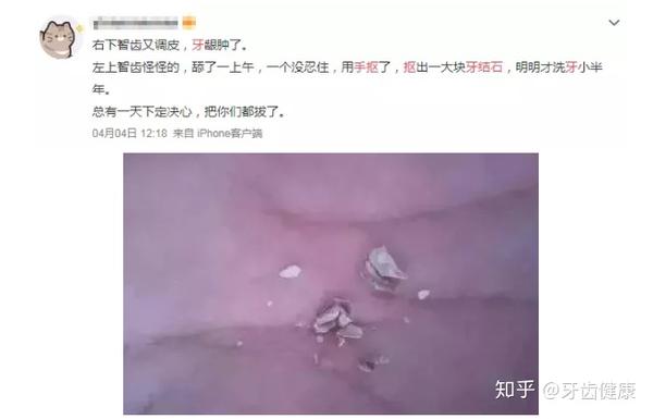 为什么刷牙之后一段时间嘴唇里面有一层白色的膜 嘴里老是掉皮 白色粘膜像鸡蛋壳壁上的粘膜一样 从来没洗过牙的你 嘴里一定有这个