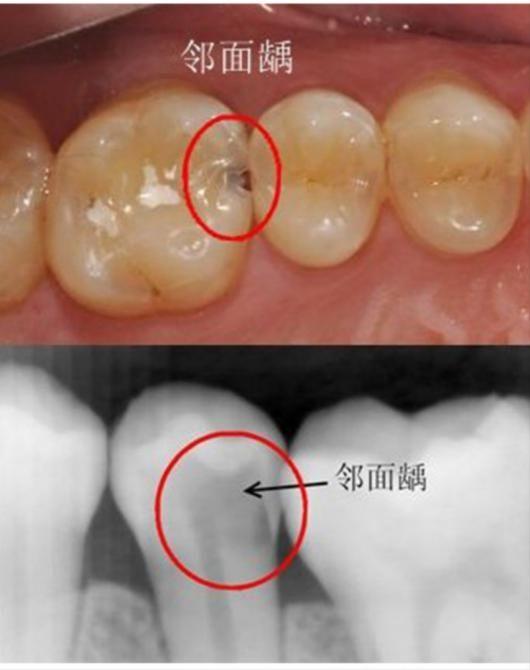 如何防止蛀牙?