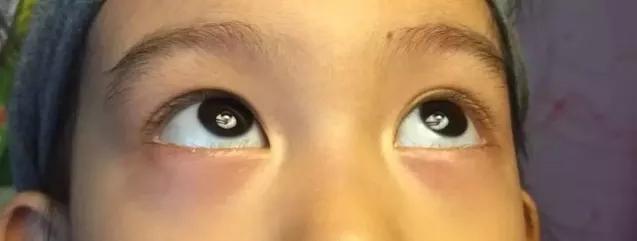 为什么孩子有眼袋,眼睑发青发红?