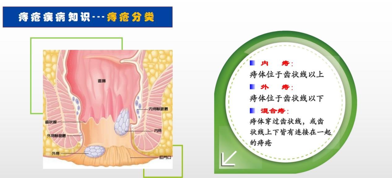 痔疮患者的误区:有肛泰痔疮药就好,其他的无所谓 - 知乎