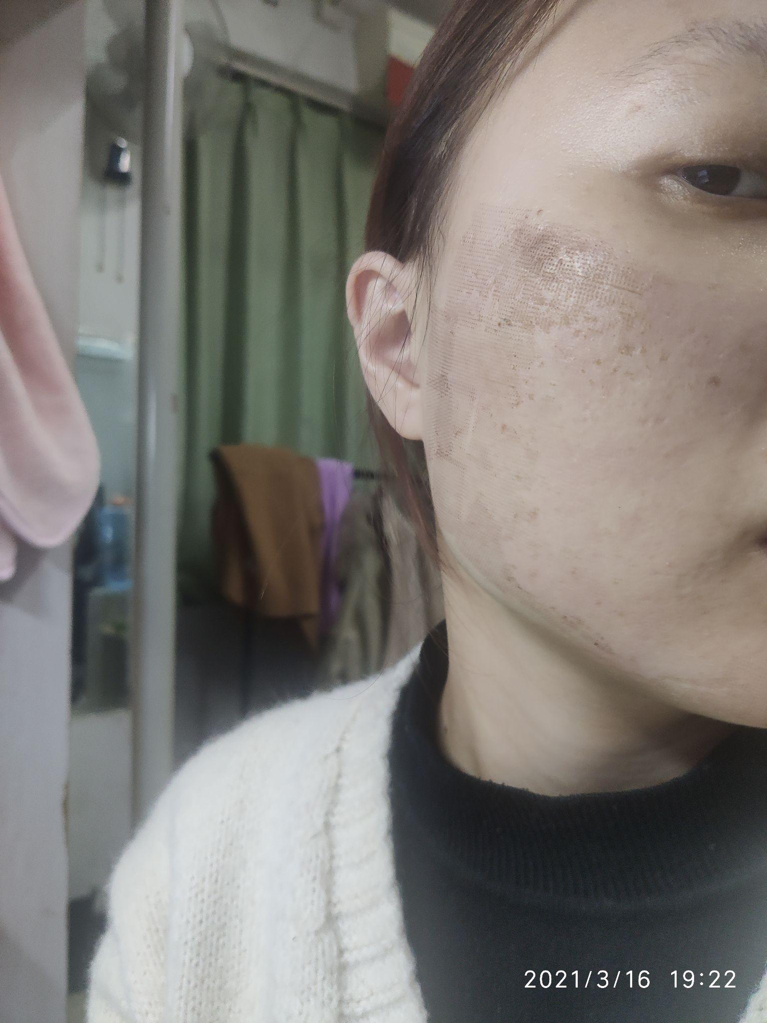 面部凹陷性疤痕修复（自体脂肪填充1次+3次点阵激光+1次手术切缝） - 知乎