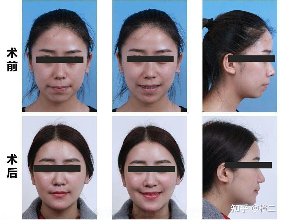 正颌手术真的有必要做吗?正颌术后能否达到标准面型?附正畸or正颌自测 - 知乎