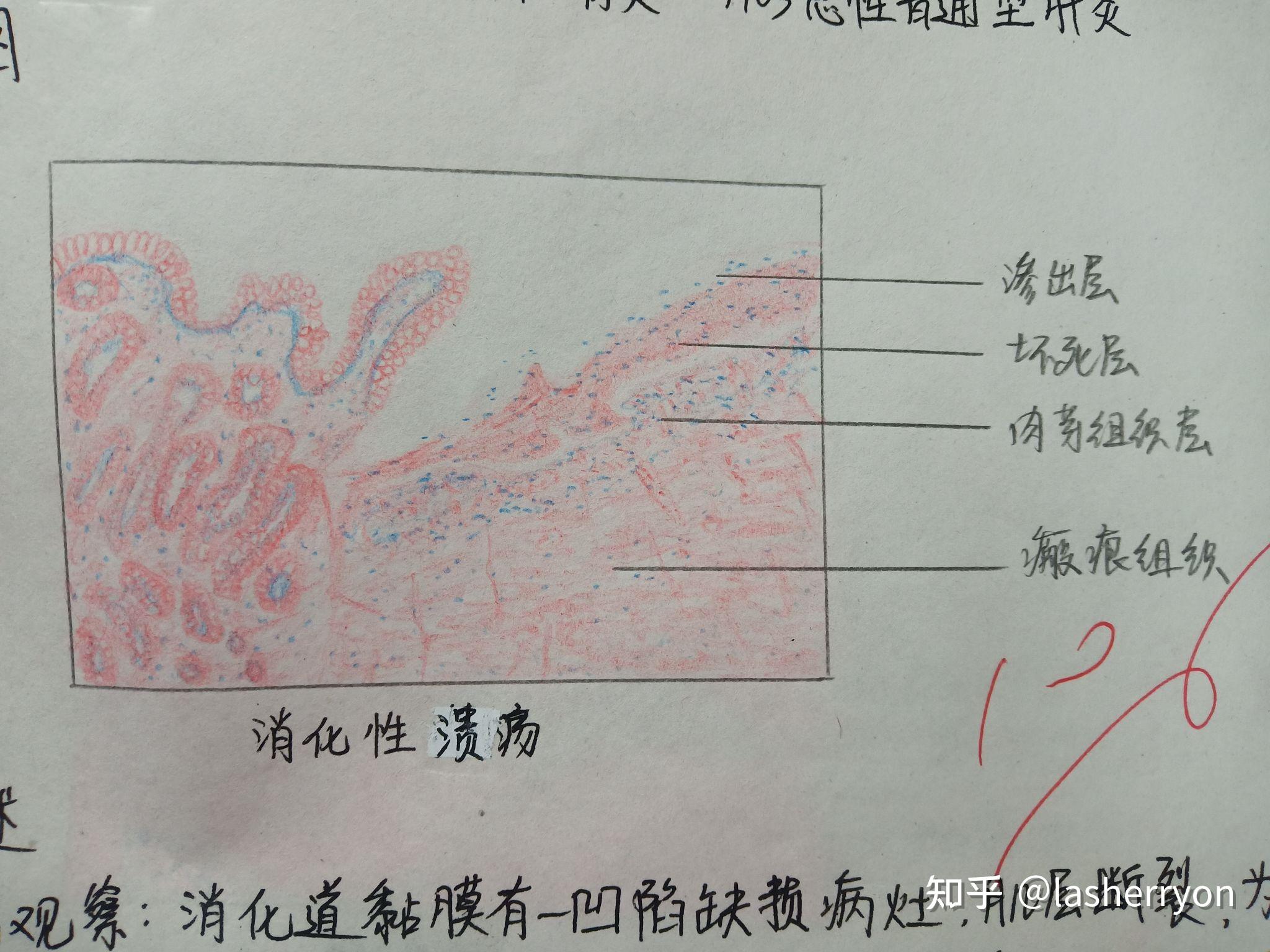 胃溃疡病理红蓝铅笔图图片