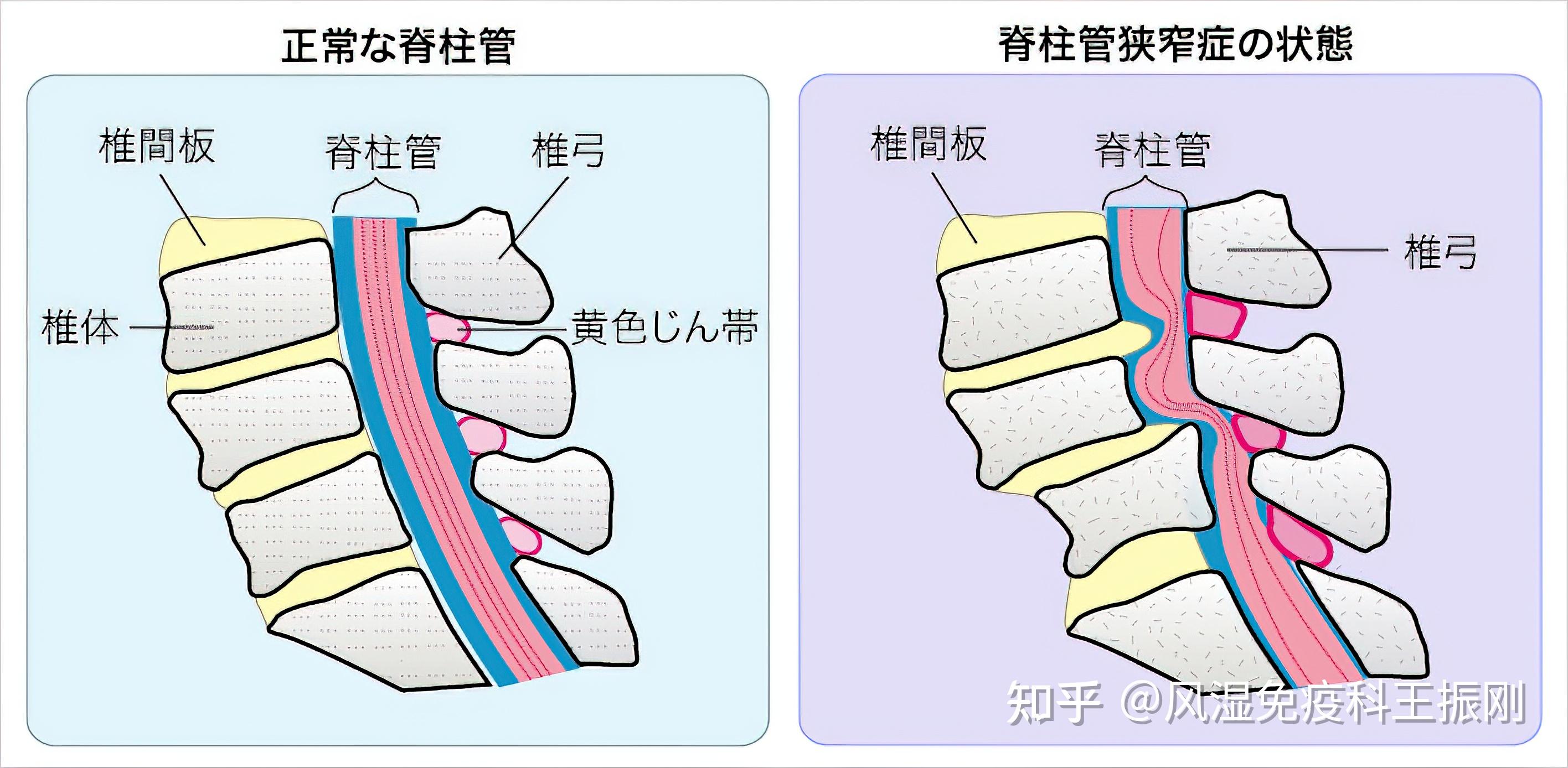 有人说颈椎病常见但危害小