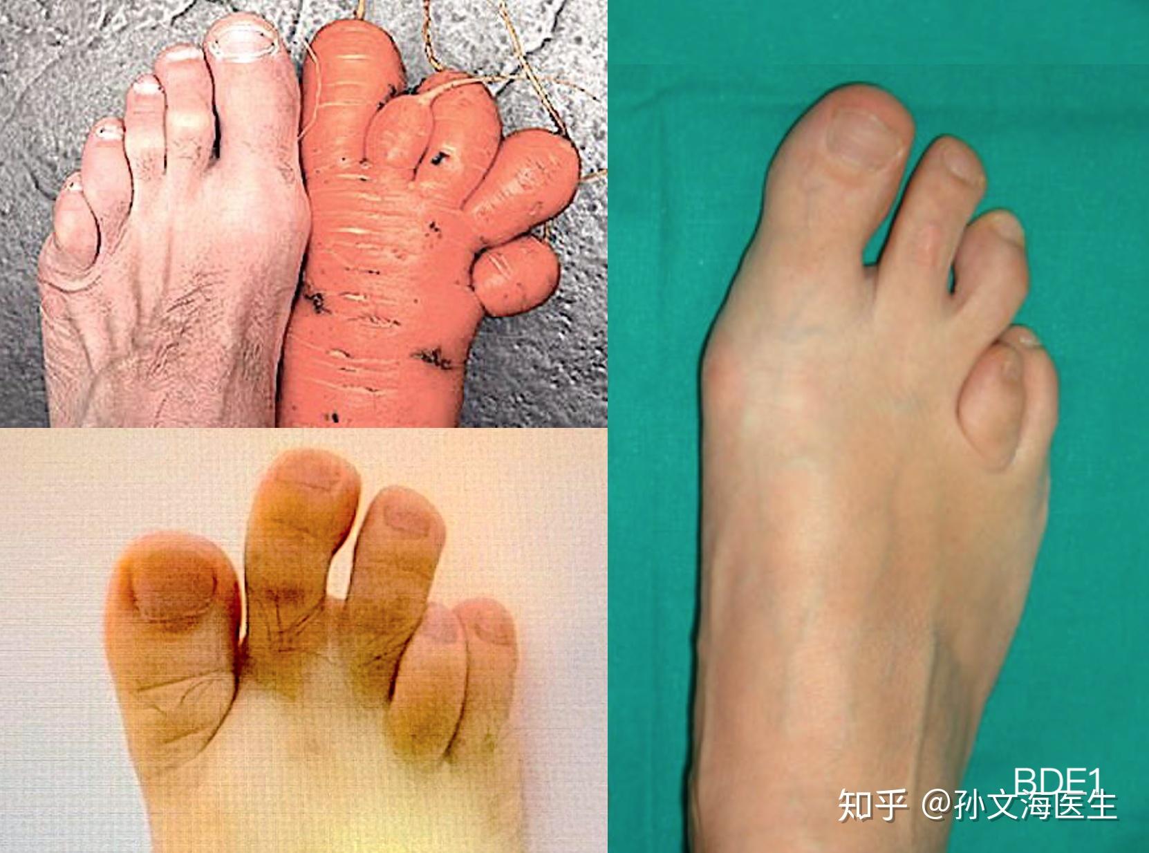 双手双脚都是六指真的非常罕见吗？会有哪些并发症？ - 知乎