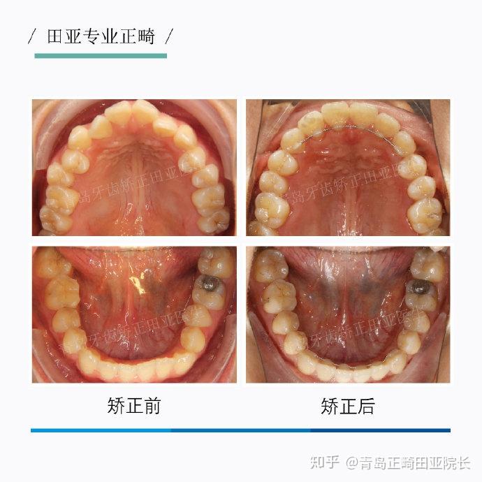 同時協調上下頜牙弓寬度,從而使尖牙段和前磨牙段牙齒恢復正常咬合和