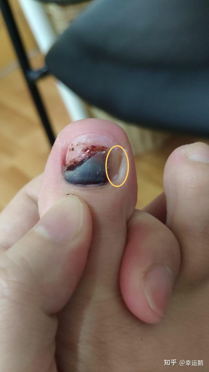 (图片可能引起不适)记录脚指甲淤血的恢复过程 