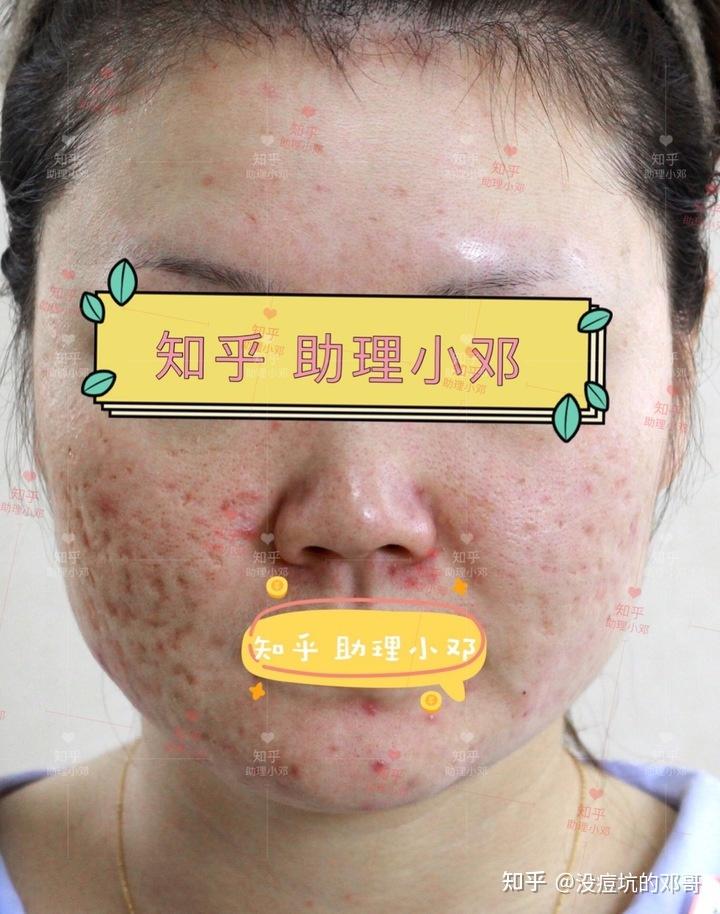 严重的冰锥滚动厢车混合类型痘坑痘痘皮肤问题目前刚做完两组治疗对比