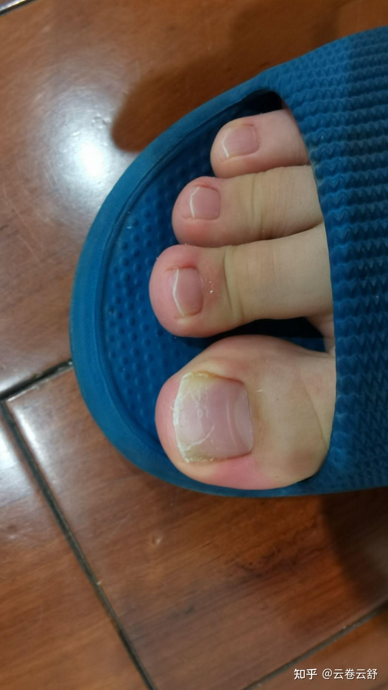 脚趾大拇指指甲两侧往肉里长怎么办啊