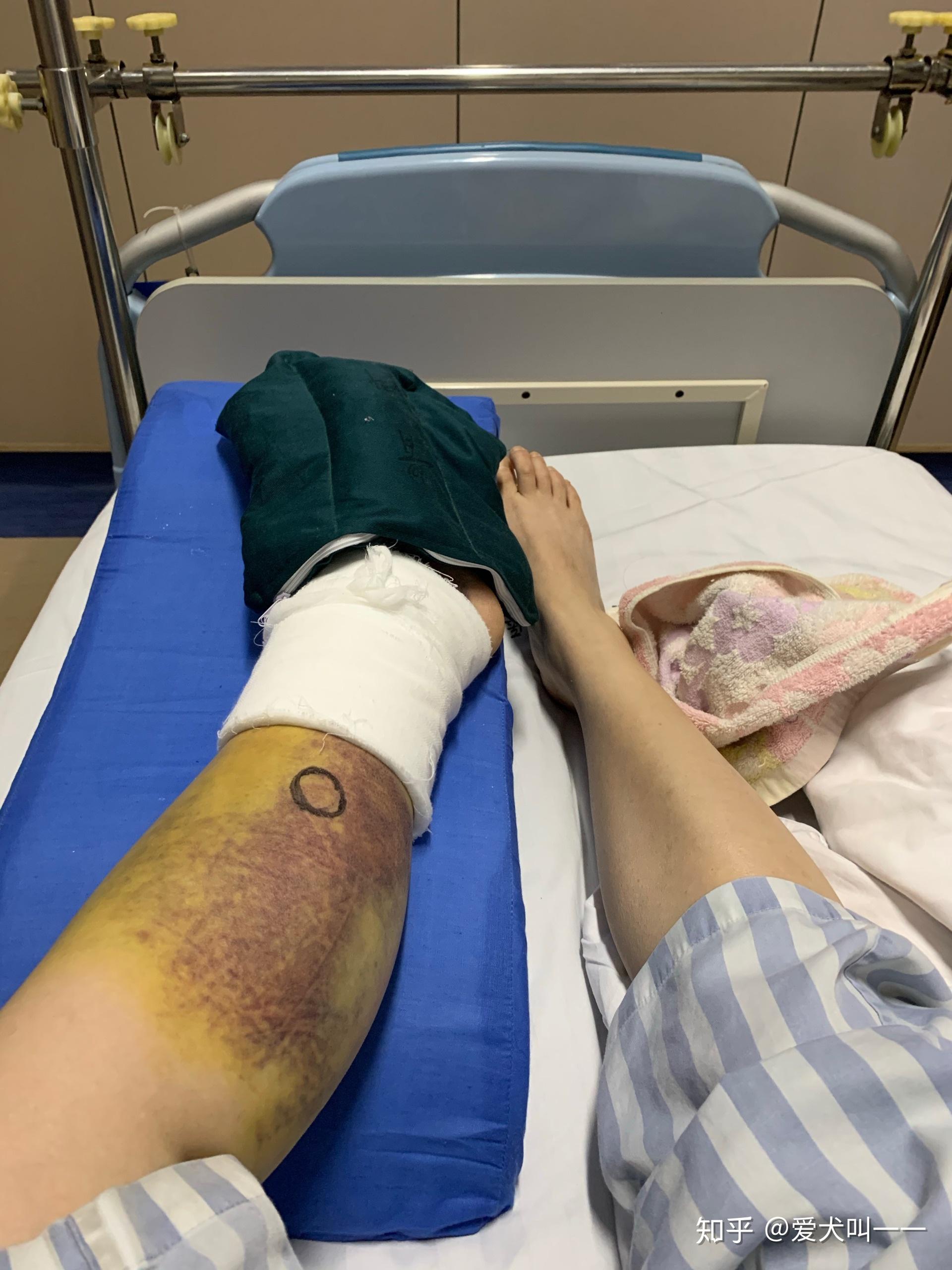 双侧脚踝骨折的手术记录
