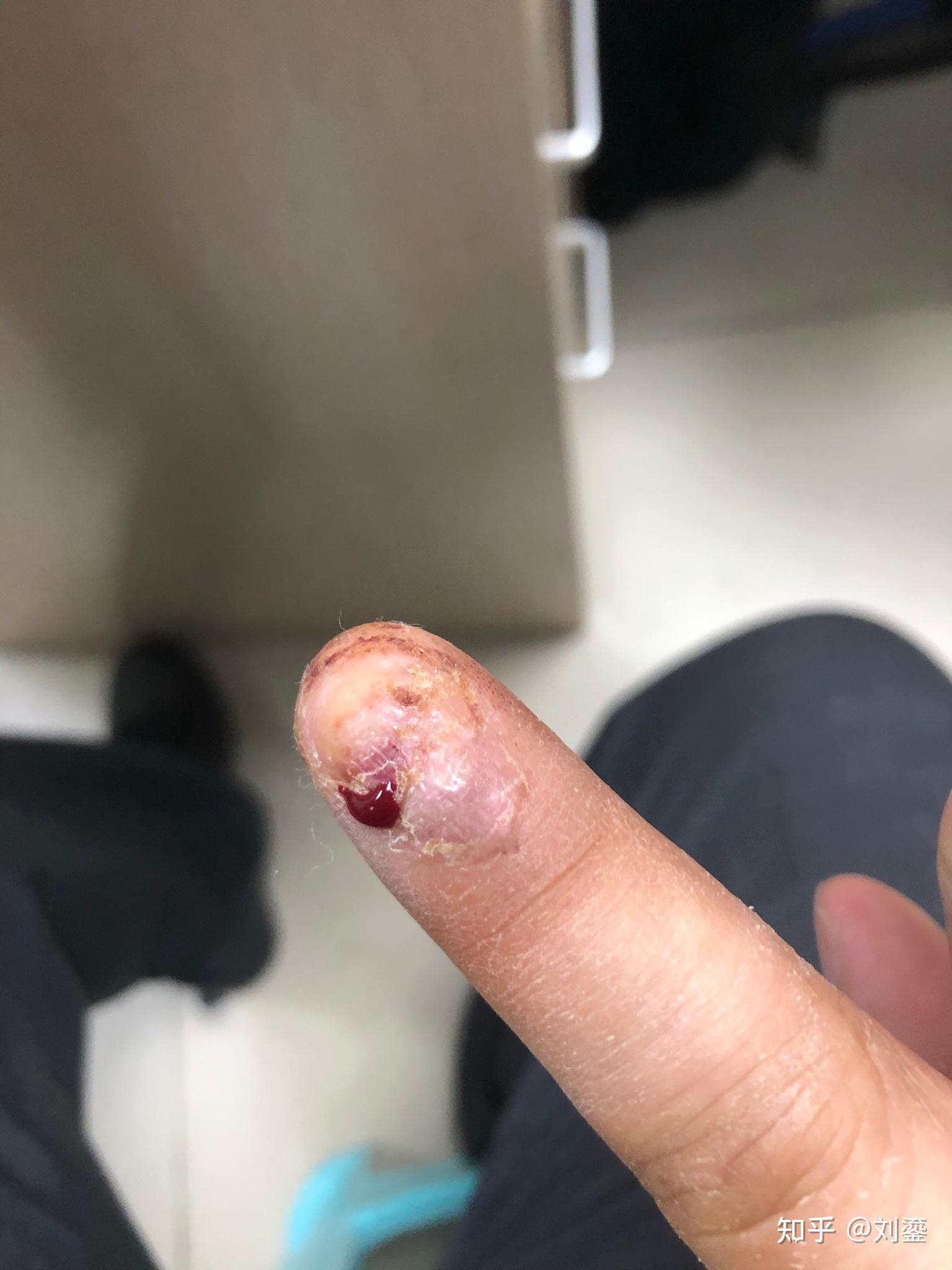 日常换药医生说不用包扎了