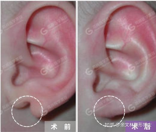 耳垂通过手术整形可以吗耳垂小没有福相可以做耳垂整形手术