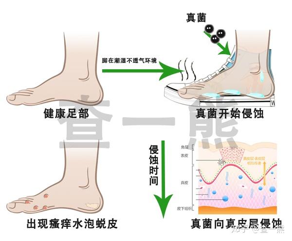 柳树叶治脚气的原理_治脚气什么方法最有效 10妙招最有效