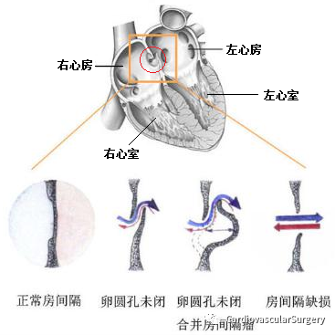 卵圆孔未闭需要治疗吗
