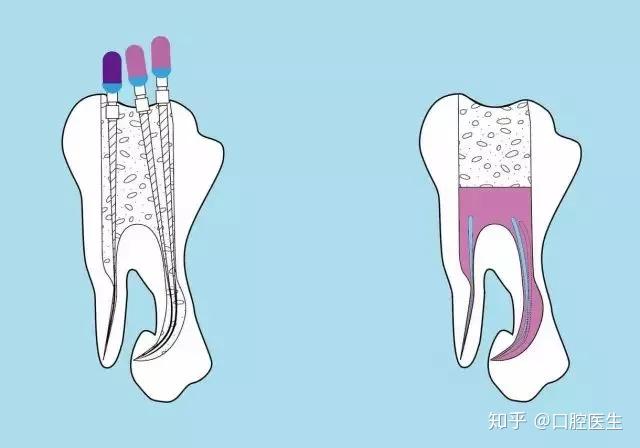 牙洞怎么治疗?单颗牙齿戴牙套有哪些危害?