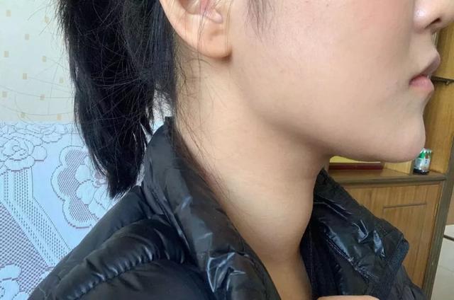 分享桥本甲减病人三个月复查三次甲功患者感言幸好没拖