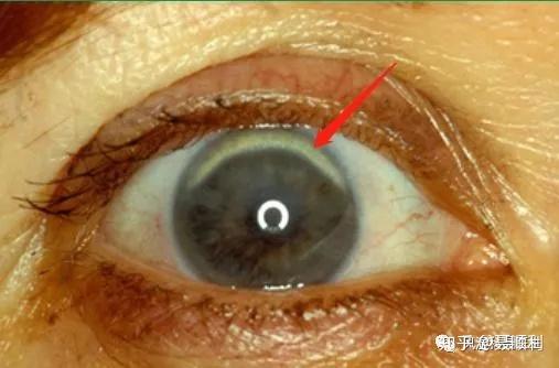 (45岁前出现脂性角膜弓,提示fh)(45岁前出现脂性角膜弓,提示fh)必须