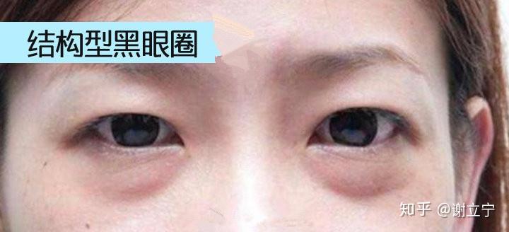 90后明星被黑眼圈送上热搜同款熊猫眼怎么救