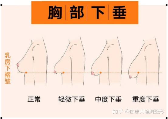 胸部下垂外扩下垂怎么办