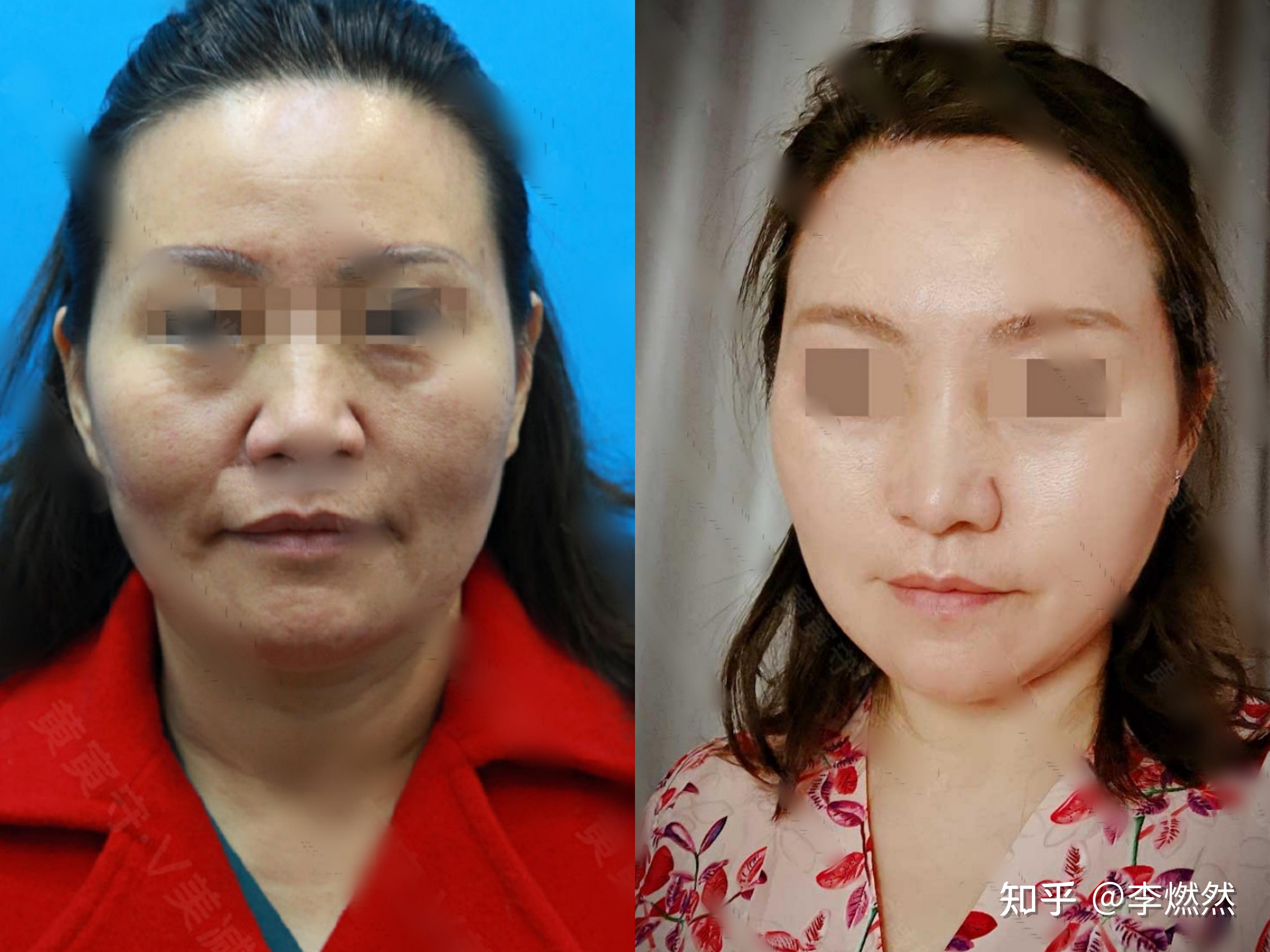 医美干货35岁女性面部松弛皮肤下垂该怎么做才能拥有20岁的年轻少女感