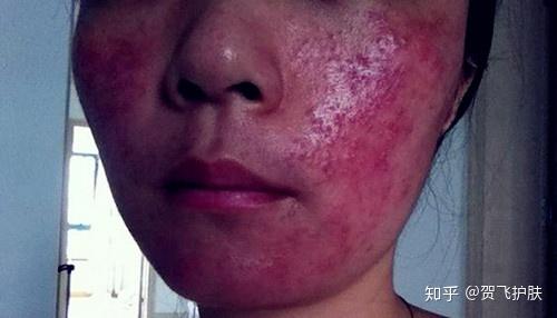 脸上反复过敏、冒痘与激素脸有关吗？ - 知乎