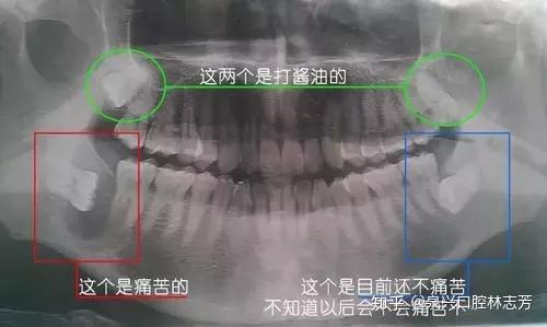 什么是智齿冠周炎？智齿冠周炎有什么危害？ - 知乎