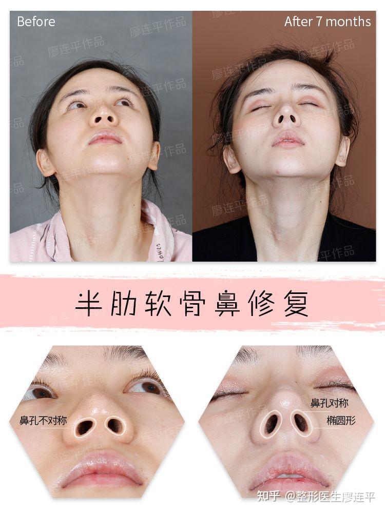 为什么说鼻孔是鼻整形最难的?鼻孔的标准形态是? - 知乎