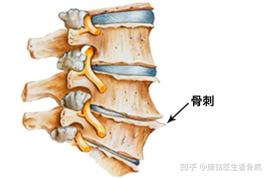 长了骨刺,怎么治疗,到底要不要开刀? - 知乎