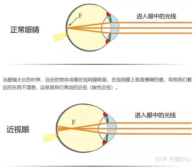 高度近视患者可以使用眼部按摩仪吗