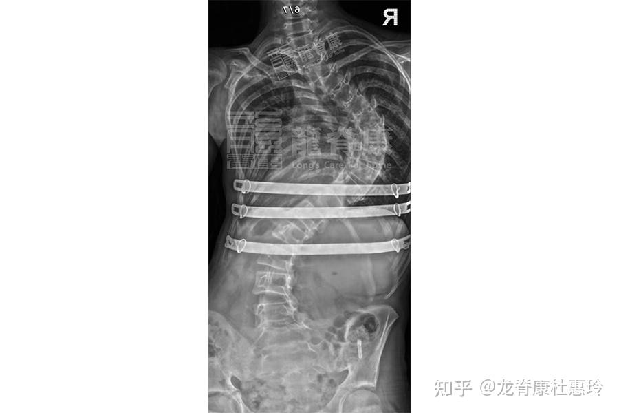 (漏斗胸引起的脊柱侧弯和胸廓畸形,建议胸廓成型术,图为胸廓成形术术