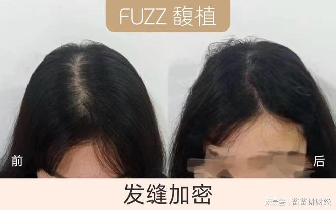发缝宽怎么办?发缝大怎么改善? - 知乎