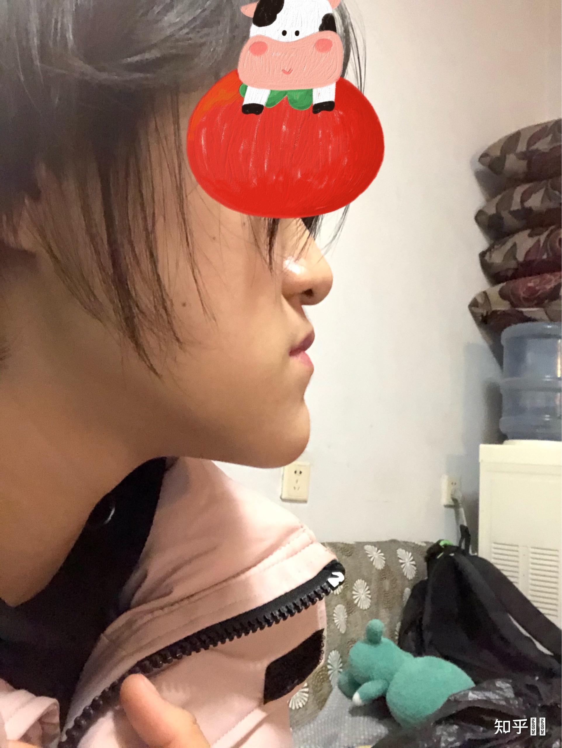 我是严重的地包天极度的自卑感觉生活没什么意义了怎么办啊