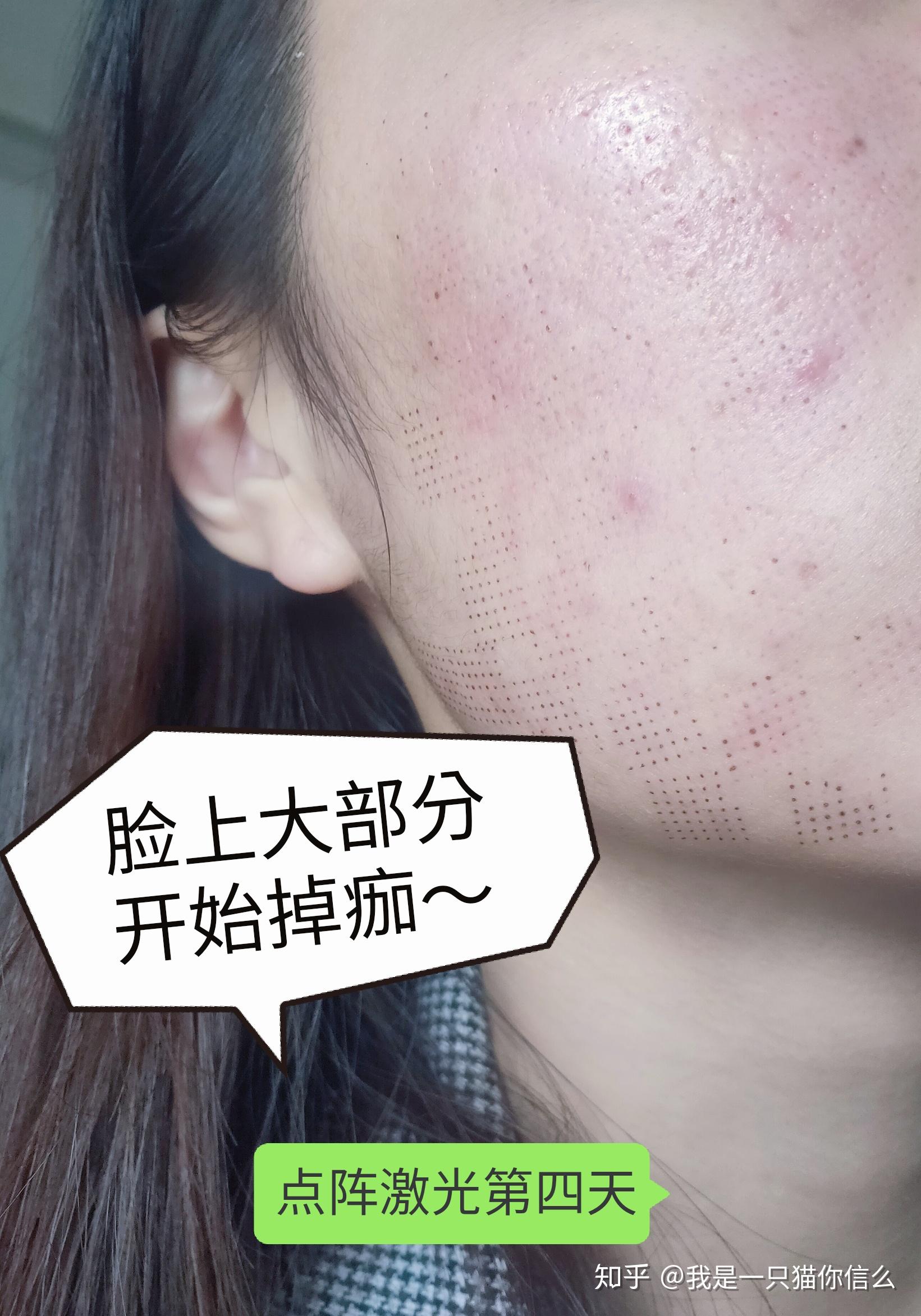 第一次点阵激光是怎么样的体验