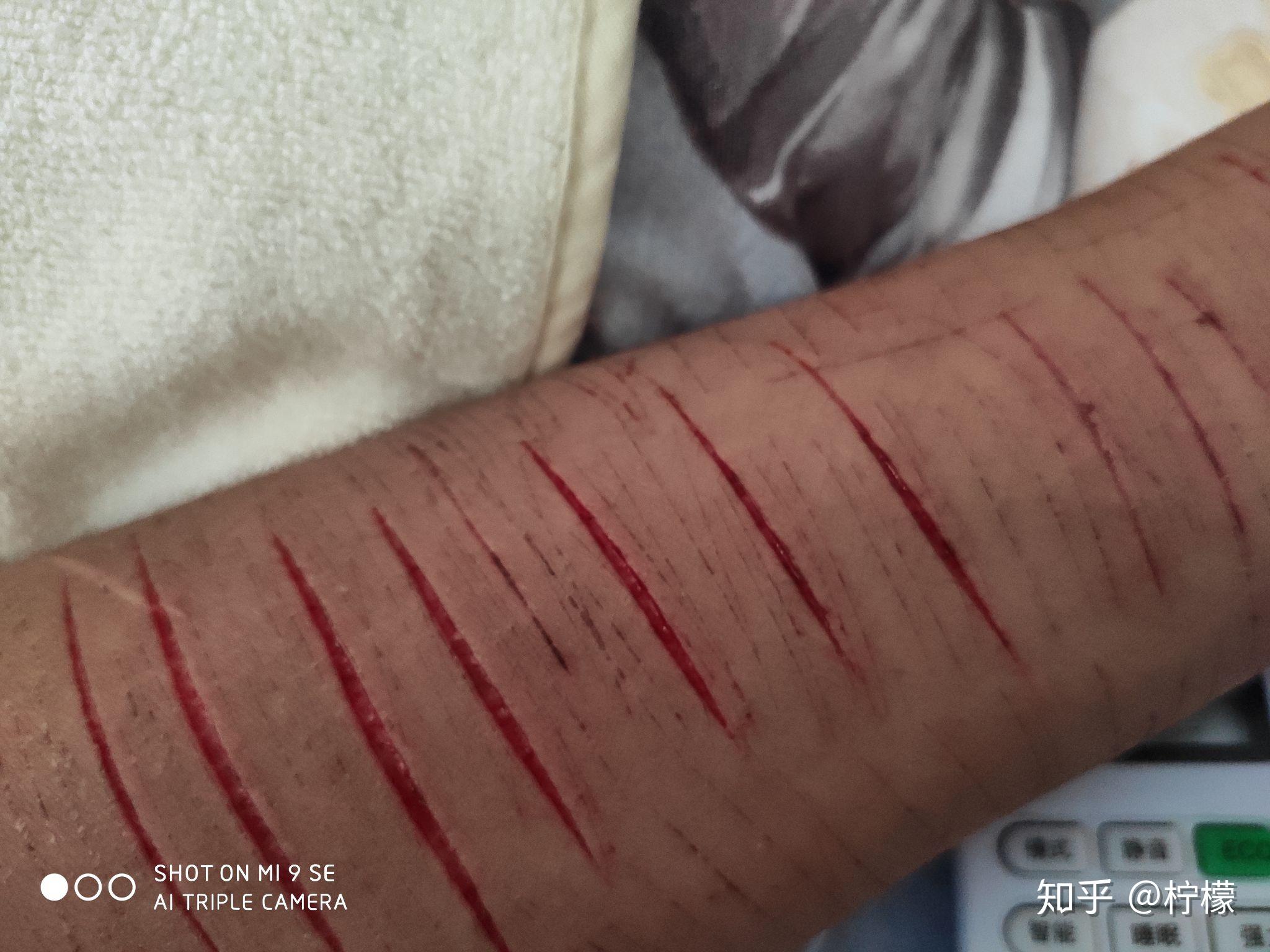 重度抑郁就算好了这样还能找到工作吗两个胳膊都这样