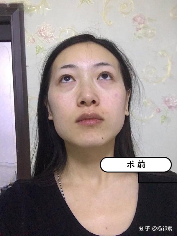 颧骨疼 脸的颧骨疼是什么原因 脸的一侧眼眶和颧骨痛