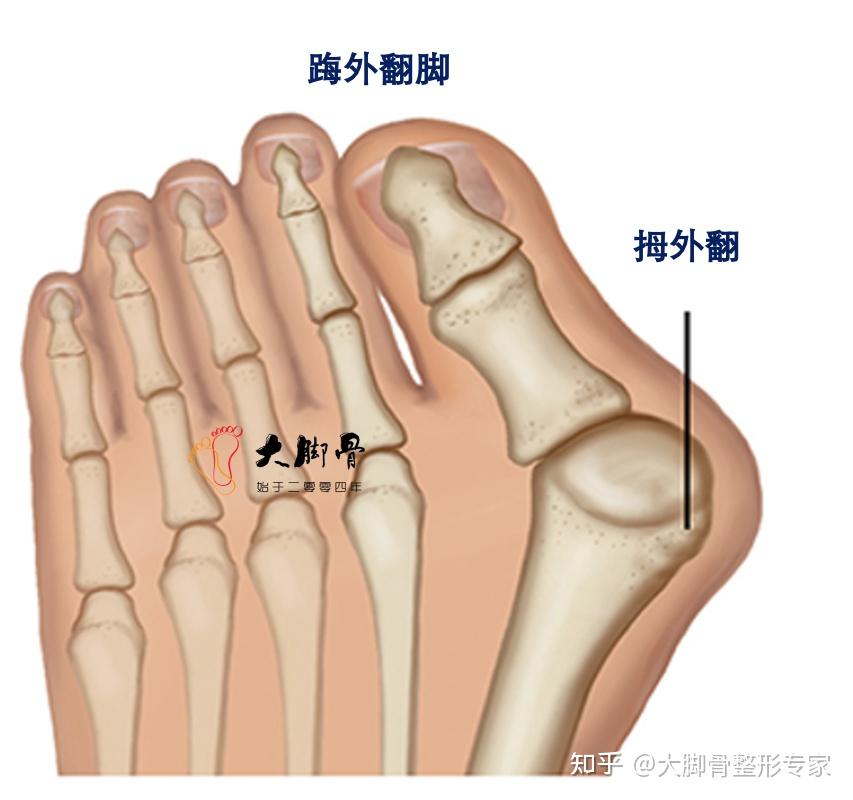 一张图看清楚拇外翻骨头问题,拇外翻里面的骨头都发生了哪些改变 - 知乎