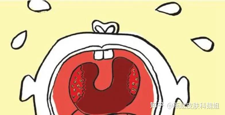 咽炎和喉炎有什么明显区别? - 知乎