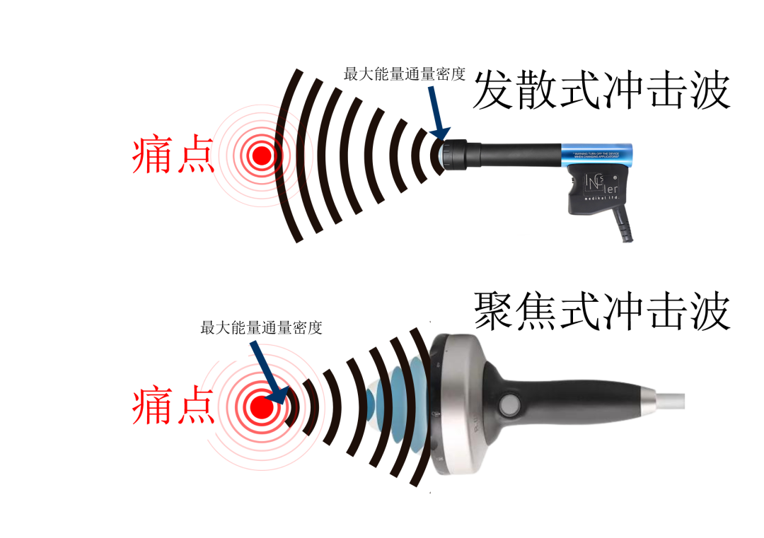 脚疼用体外冲击波,还是超声波? - 知乎