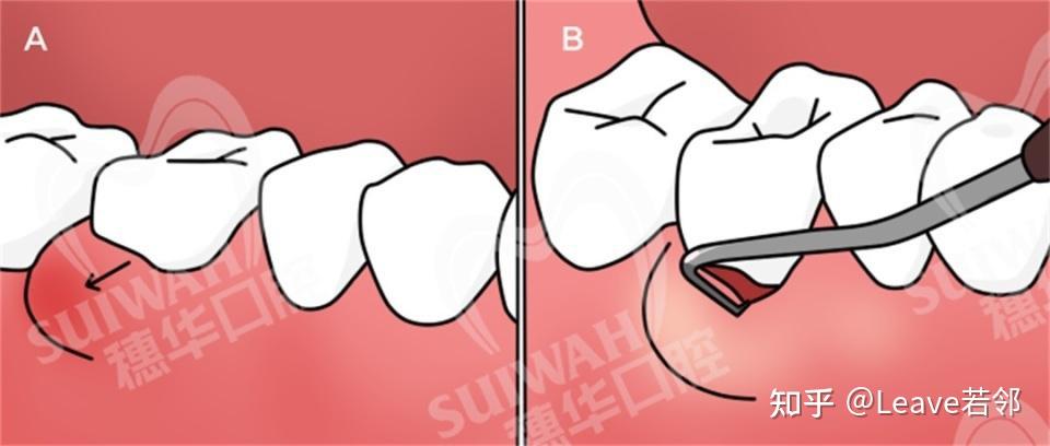  牙周深度清潔有必要做嗎_牙周深度清潔有必要做嗎